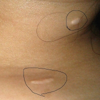 什么是疤痕体质的增生性疤痕 - 整形美容 - 中国