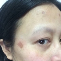 如何淡化疤痕色素 - 疤痕美容-中国疤痕论坛