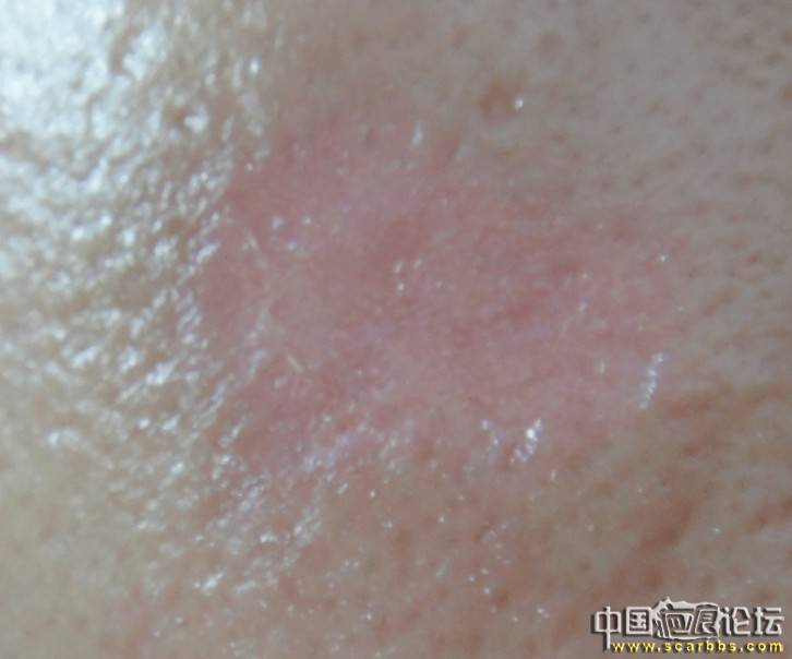 痤疮留下凹陷疤痕,用什么药物可以改善-信息交