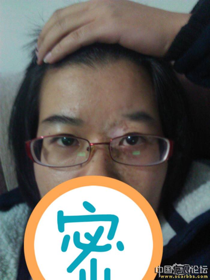 毛细血管瘤治愈后疤痕-图片疤痕-中国疤痕论坛