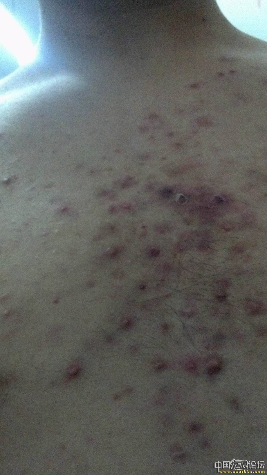 我刚刚在北京协和医院整形医院(八大处)做了点