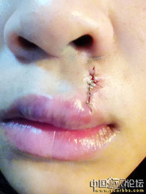 今天刚做了切痣手术-普通疤痕-中国疤痕论坛-网