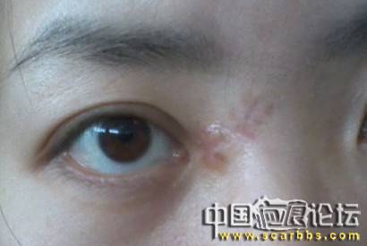 手术切痣+疤痕,纠结啊!做过的朋友请进来交流
