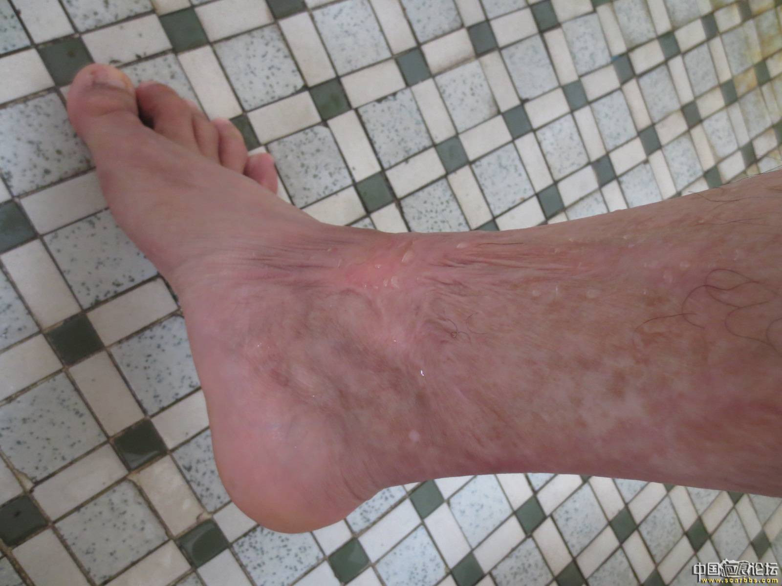 我小时候被开水烫伤在脚上,已经有二十几年了