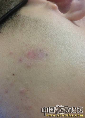 【申精】我的瘢痕疙瘩平了!不用吃药打针同位