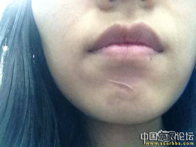 下巴20年的刀疤能治疗吗 - 普通疤痕 - 中国疤痕