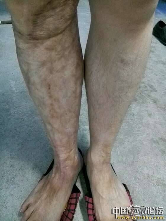 激光去扁平疣后脸上留下红印如何修复? - 信息