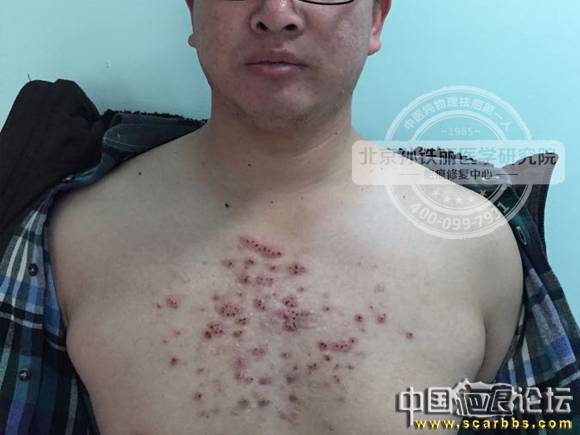 【孙铁丽疤痕义诊】何先生胸前疤痕疙瘩治疗直