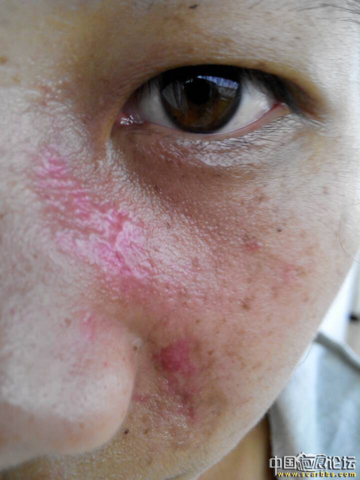 光动力治疗红胎记,手术后第二个月在胎记上长