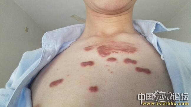 胸前和两手臂的疤痕疙瘩是因为挤痘痘造成的