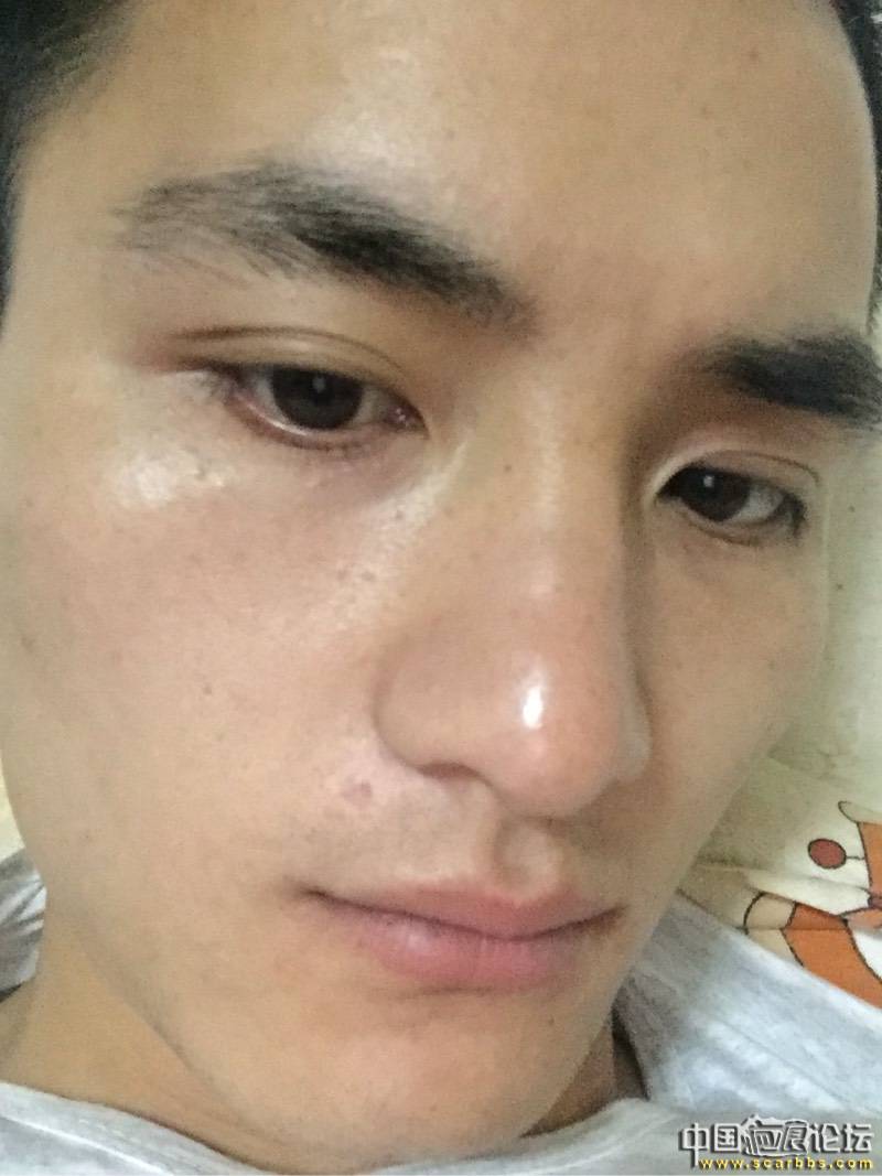 手术切除凹坑,大家看看效果怎么样? - 第3页 - 图