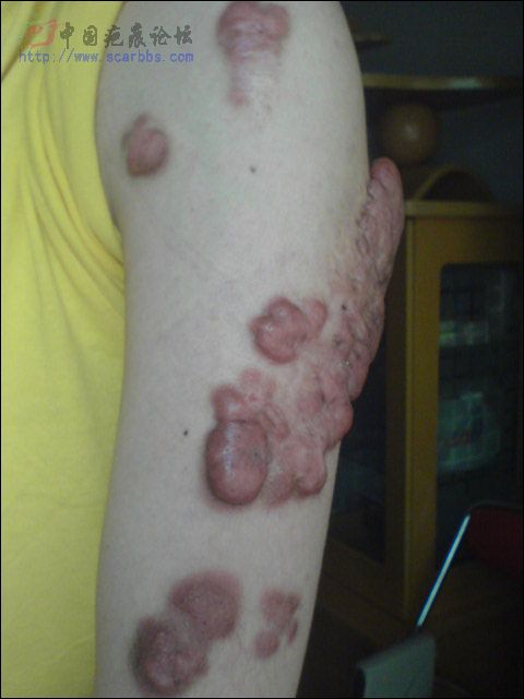 【瘢痕疙瘩】疤痕之痛,一生叹惜-图片疤痕-中国