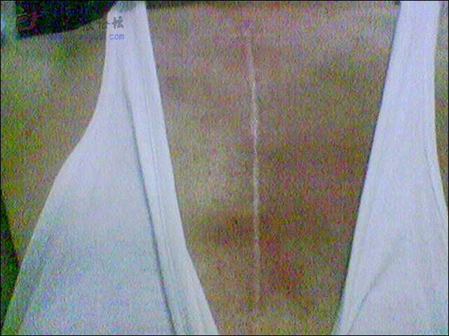 请教两年后的开胸手术疤痕如何治疗好呢(附疤痕