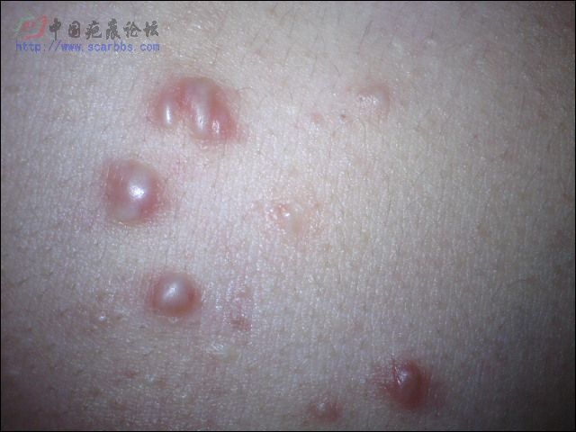 请问我这是疤痕疙瘩么? 大家一定要进来看看