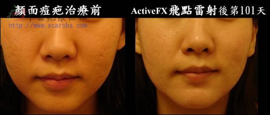 点阵激光确实是最好的治疗手段了-青春痘疤-中