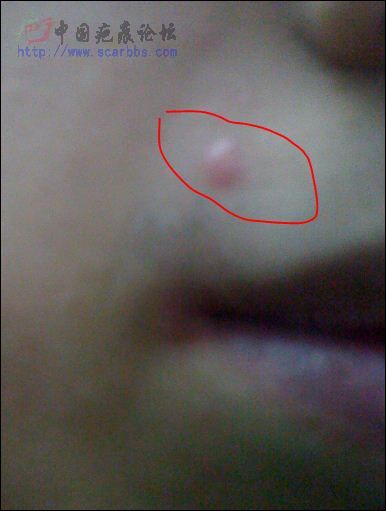 激光点痦子留下突出的疤痕,怎么处理好-图片疤
