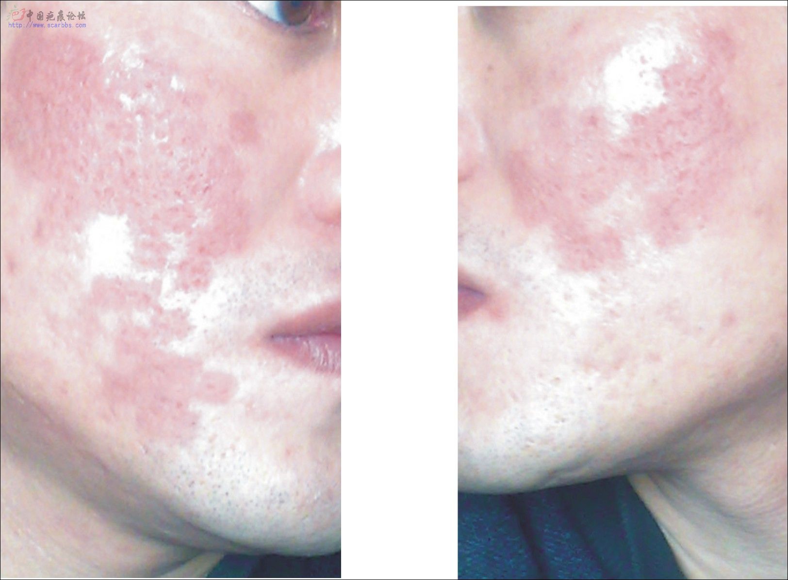 做完点阵激光(带图片)-青春痘疤-中国疤痕论坛