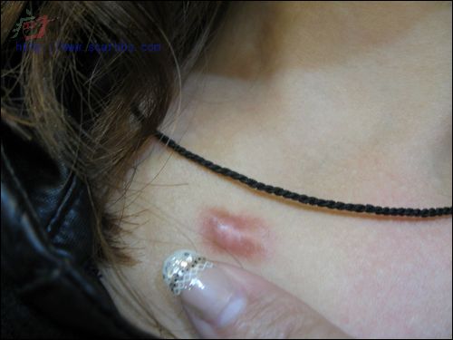 请问我胸前这个疤痕疙瘩该怎么治疗 - 疤痕疙瘩