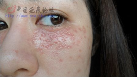 湖南省医做的点阵激光 掉痂一周有凹陷 怎么办