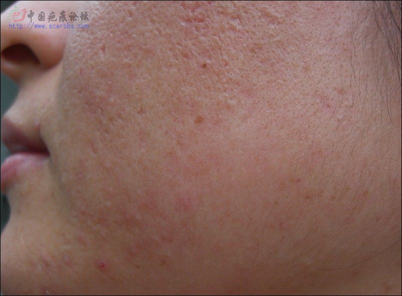 有跟我类似的 凹坑 做过飞梭的吗?大家救救我的