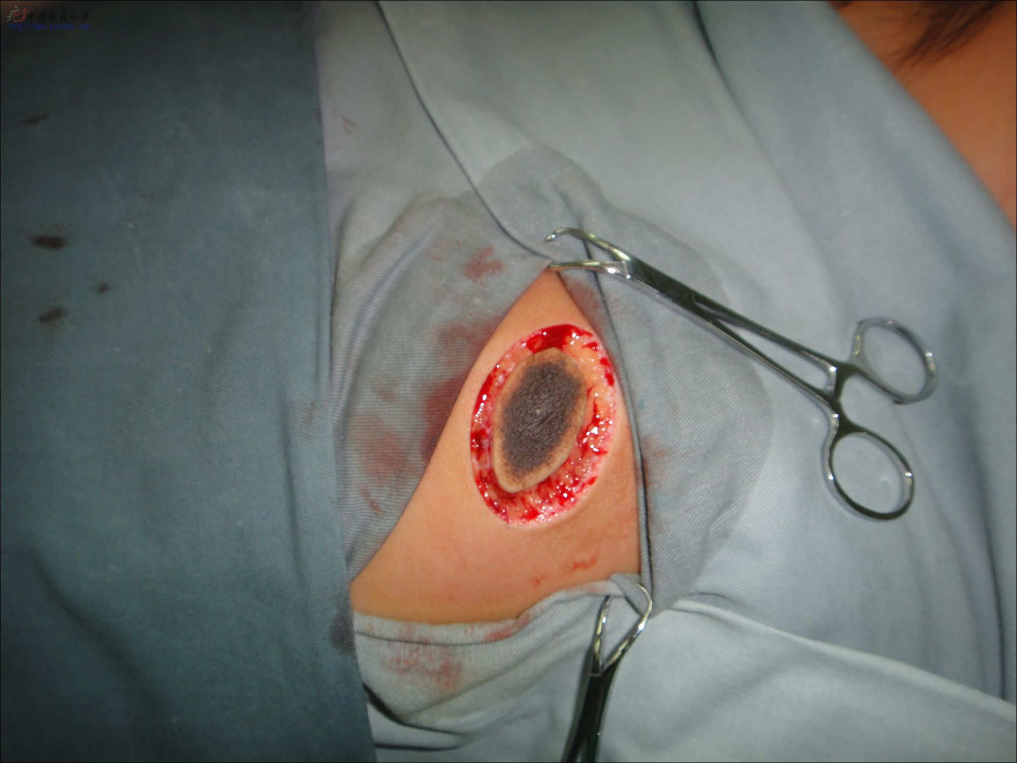 图示整形外科学原则在痣、疤痕切除整形手术