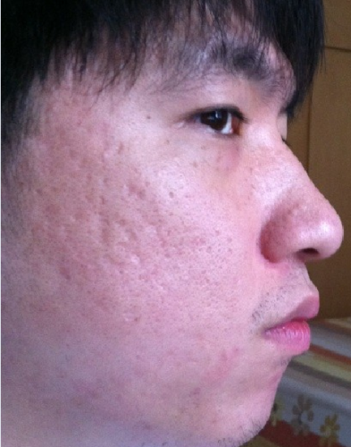 想请教下我这脸适合什么样的治疗？ 